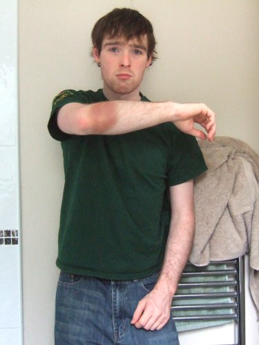 My bruised arm
